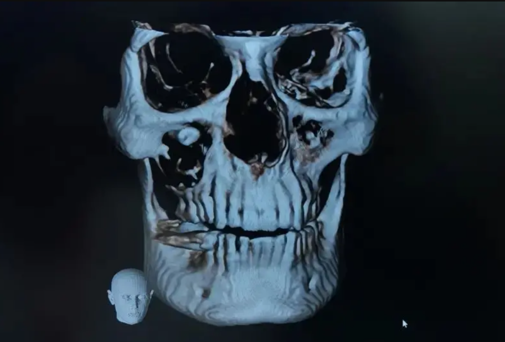 বিহারে বিরল অস্ত্রোপচার, রোগীর চোখ থেকে অপসারণ করা হলো দাঁত » DENTAL TIMES