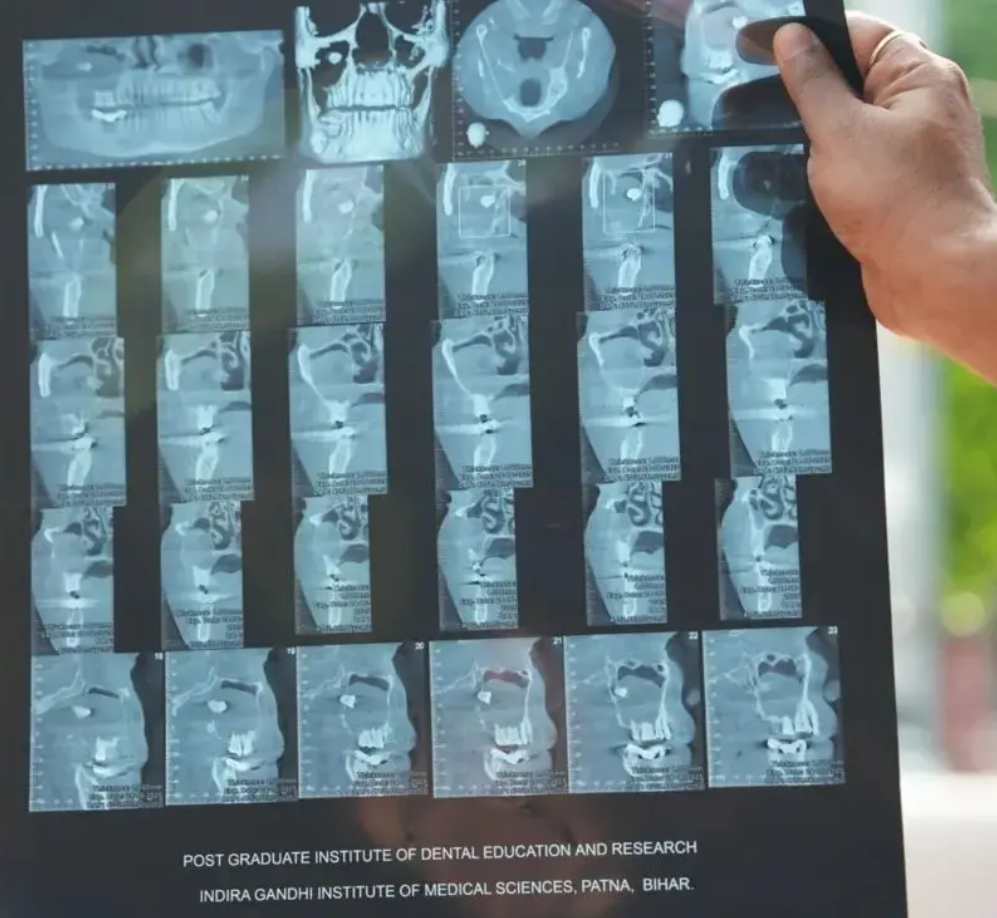 বিহারে বিরল অস্ত্রোপচার, রোগীর চোখ থেকে অপসারণ করা হলো দাঁত » DENTAL TIMES