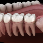 আক্কেল দাঁতে ব্যথা হওয়ার কারণ &raquo; DENTAL TIMES