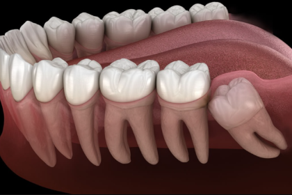 আক্কেল দাঁতে ব্যথা হওয়ার কারণ &raquo; DENTAL TIMES