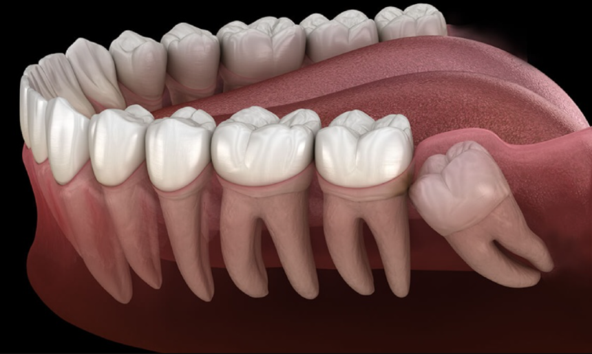আক্কেল দাঁতে ব্যথা হওয়ার কারণ &raquo; DENTAL TIMES
